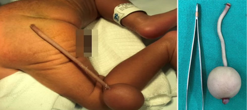 BABY HAS 12CM-LONG APPENDAGE WITH BALL ON THE END