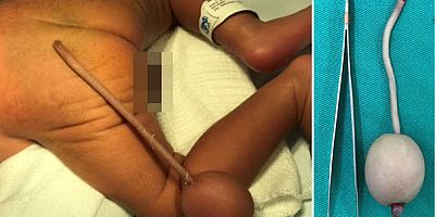 BABY HAS 12CM-LONG APPENDAGE WITH BALL ON THE END
